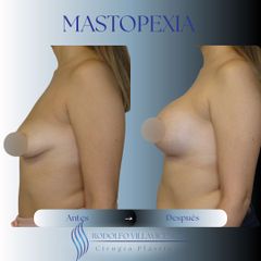 Mastopexia - Dr. Rodolfo Villavicencio
