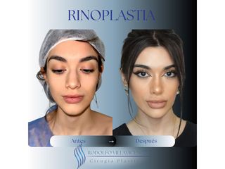 Rinoplastia - Dr. Rodolfo Villavicencio