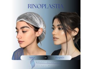 Rinoplastia - Dr. Rodolfo Villavicencio