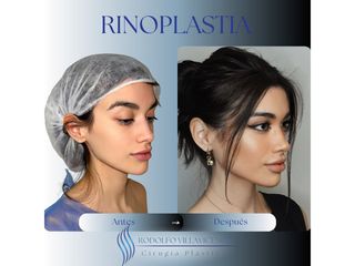 Rinoplastia - Dr. Rodolfo Villavicencio