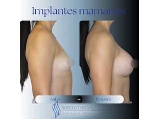 Aumento Mamas - Dr. Rodolfo Villavicencio