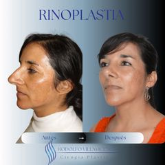 Dr. Rodolfo Villavicencio - Rinoplastia