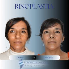 Dr. Rodolfo Villavicencio - Rinoplastia