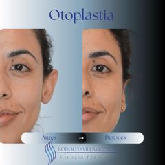 Otoplastia - Dr. Rodolfo Villavicencio