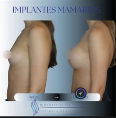 Aumento Mamas - Dr. Rodolfo Villavicencio