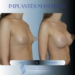 Aumento Mamas - Dr. Rodolfo Villavicencio