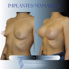 Aumento Mamario - Dr. Rodolfo Villavicencio