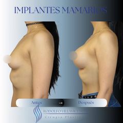 Aumento Mamas - Dr. Rodolfo Villavicencio