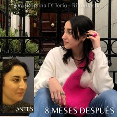 Rinoplastia - Di Iorio - Cajelli