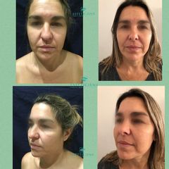Rinoplastia