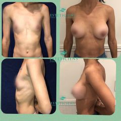 Aumento mamario 325 cc retromuscular periareolar
