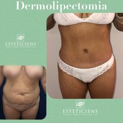 Dra. Mariana Bouvier - Abdominoplastia