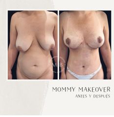 Dermolipectomía - Dra. Mariana Bouvier