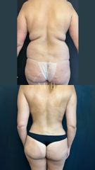Liposucción - Dra. Mariana Bouvier