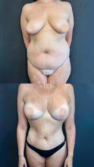 Abdominoplastia - Dra. Mariana Bouvier
