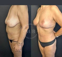 Mastopexia -Dra. Mariana Bouvier