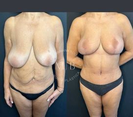Mastopexia - Dra. Mariana Bouvier