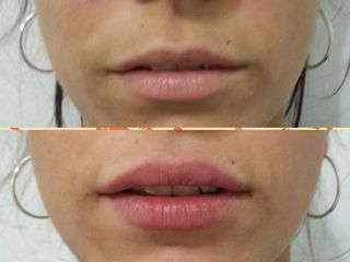 Relleno de labios con ácido hialurónico Dra. Solimano