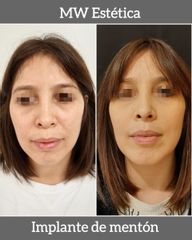Implante de mentón - antes y después