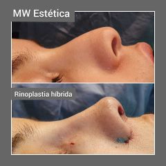Rinoplastia híbrida - Mw Estética