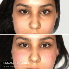 Eliminación de ojeras - Dr. Fernando Glaria