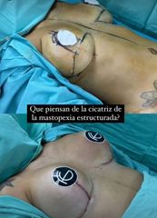 Mastopexia Estructurada - Dr. Fernando Glaria