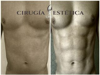 Lipomarcación HD. De abdomen y pectoral 