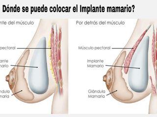 Retroglandular vs Retromuscular