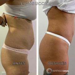 Liposucción - Estetica Casal