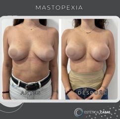 Mastopexia - Estetica Casal