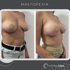 Mastopexia - Estetica Casal