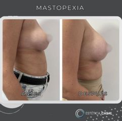 Mastopexia - Estetica Casal