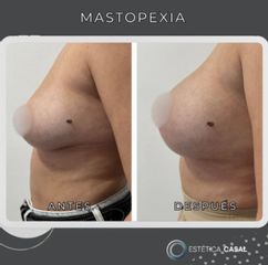 Mastopexia - Estetica Casal