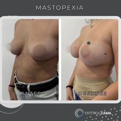 Mastopexia - Estetica Casal