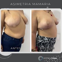 Asimetria Mamaria - Estetica Casal