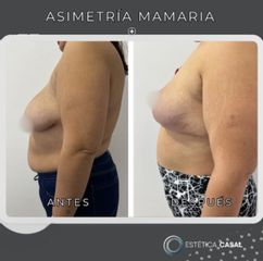 Asimetria Mamaria - Estetica Casal
