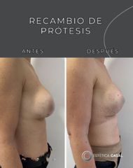 Recambio de Prótesis - Estética Casal