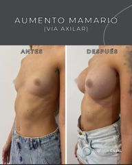 Aumento Mamas - Estética Casal