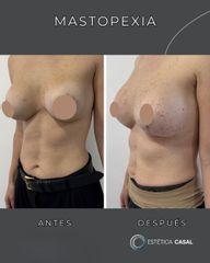 Mastopexia - Estetica Casal