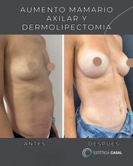Aumento Mamario y Dermolipectomia - Estetica Casal