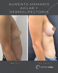 Dermolipectomia y Aumento Mamario - Estetica Casal