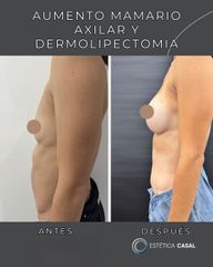 Dermolipectomia y aumento mamario - Estetica Casal