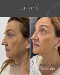 Lifting - Estetica Casal