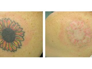 Tratamientos corporales - Remover tatuajes con Láser Harmony XL