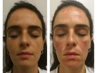 Tratamientos faciales - Manchas en la piel con Láser Harmony