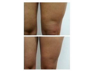 Subsición-para-celulitis
