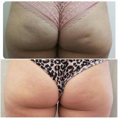 Tratamientos celulitis - Medvital