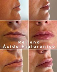 Rellenos de Labios con Acido Hialuronico - Medvital