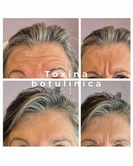Botox - Medvital
