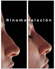 Rinomodelación - Medvital